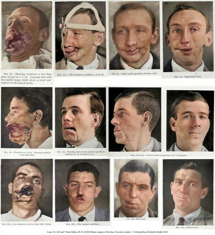 Historical medical cases showing facial reconstruction and healing progress in early 20th-century surgery photographs.