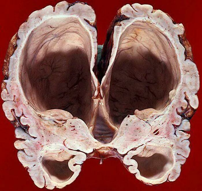 Hydrocephalus Ex Vacuo With Some Extensive White Matter Atrophy