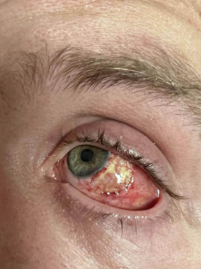 Close-up of a human eye showing a rare medical condition, illustrating the complexity of the human body.