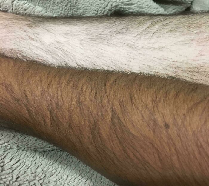 Mi piel bronceada y sin broncear