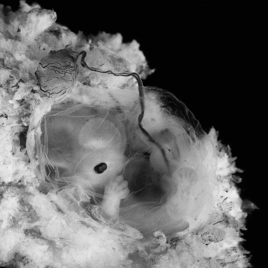 Meet Lennart Nilsson, The Photographer Who Spent 12 Years Photographing The Development Of Fetuses