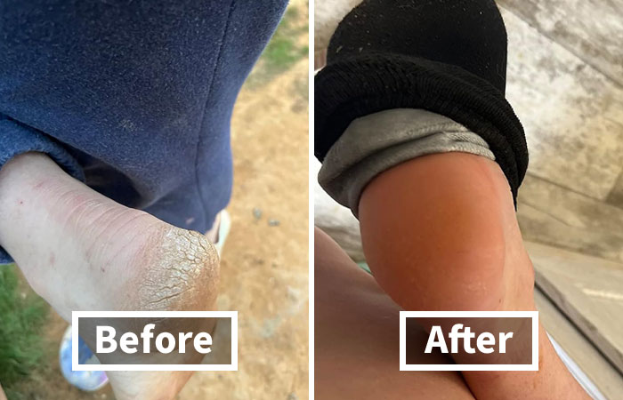 Sole-Ful Healing: Dr. Frederick’s Secret To Silky Smooth Steps