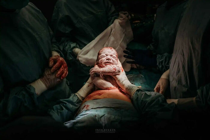 Honorable Mention: "Her Baby, Her Birth, Her Way (Maternal Assisted Caesarean)", Inge Berken, Netherlands