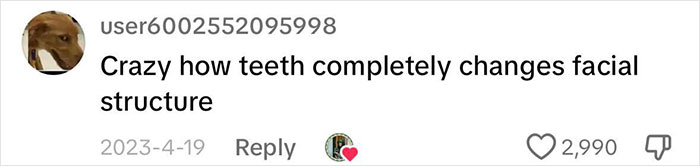 After Having All Her Teeth Pulled Out At 20, Woman Shares &ldquo;Before/After&rdquo; Implants Transformation