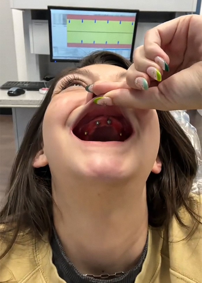 After Having All Her Teeth Pulled Out At 20, Woman Shares &ldquo;Before/After&rdquo; Implants Transformation
