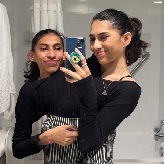 Conjoined Twins Speak Out After Viral Photos Leave People With A Mountain Of Questions