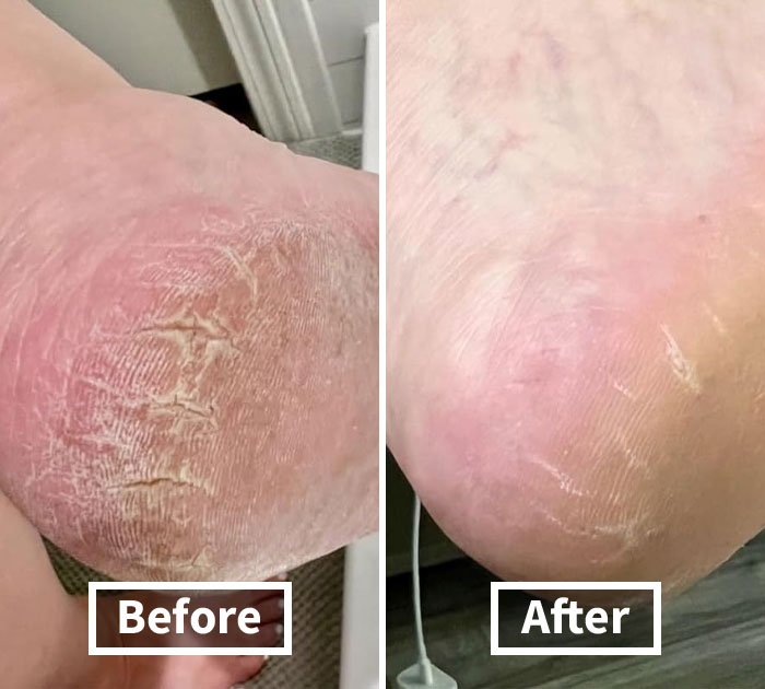 Pamper Your Feet With Dr. Scholl's Heel Repair Balm And Say Goodbye To Dry, Cracked Heels. Your Feet Will Thank You, Especially After All Those Holiday Parties!