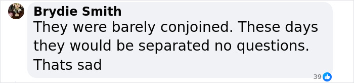 People Learn Harrowing Story Of Conjoined Twins, Which Ended With One Alive And The Other Not - 9