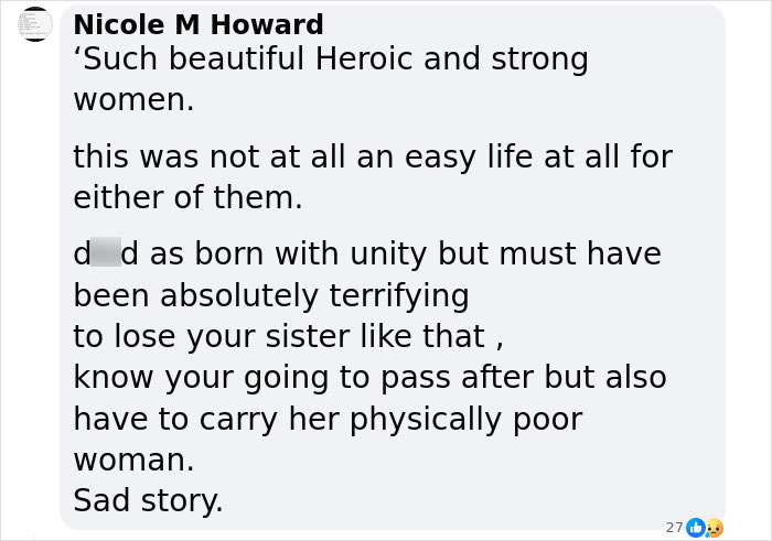 People Learn Harrowing Story Of Conjoined Twins, Which Ended With One Alive And The Other Not - 10