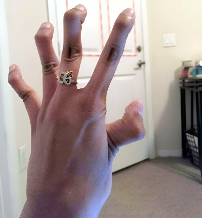 I Have Marfan Syndrome And I'm Double-Jointed