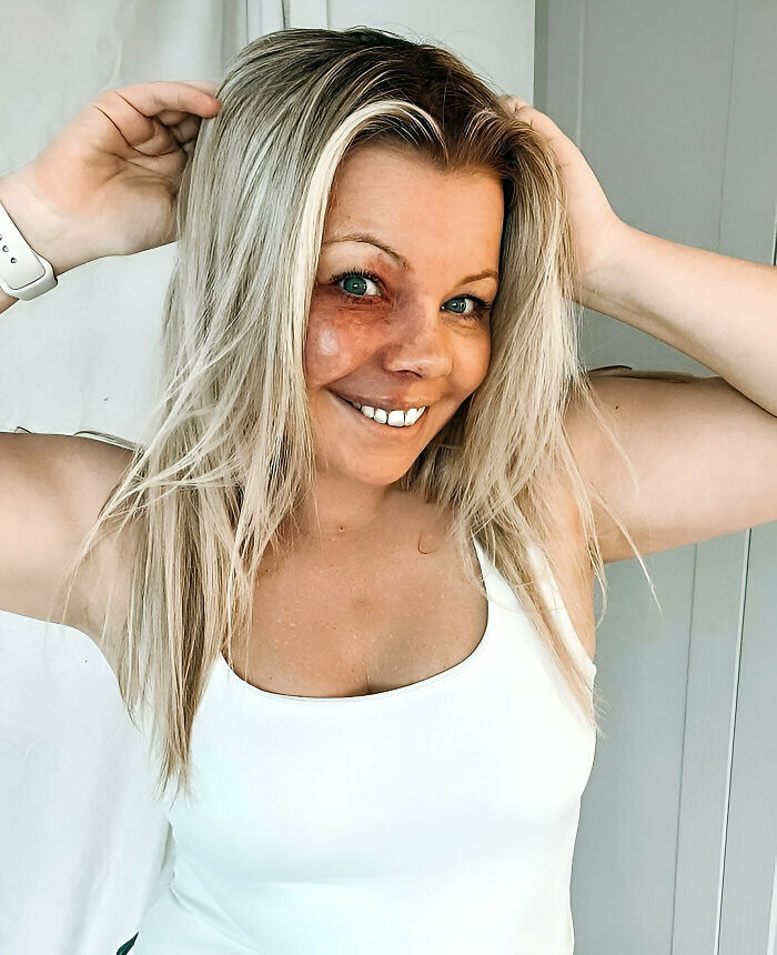 I Was Born With A Port Wine Stain Birthmark On The Left Side Of My Face. I’ve Never Let It Stop Me From Doing The Things I Want To Achieve