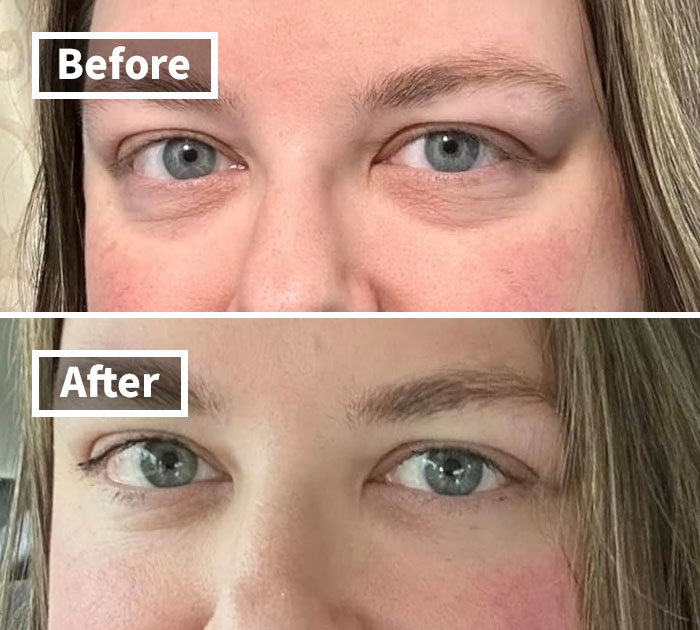 Close-up before and after photos showing reduced under-eye bags and smoother skin as adulting for beginners tricks improve appearance.