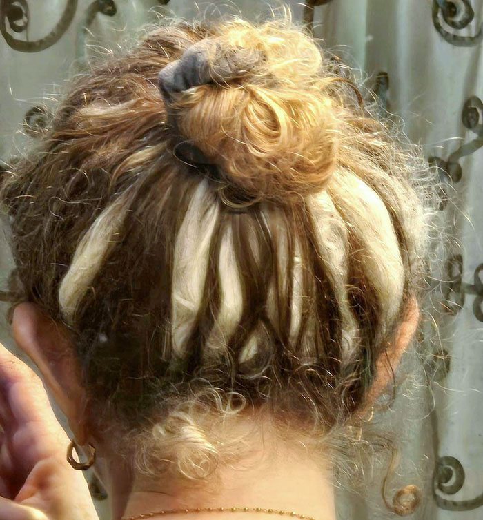 My Vitiligo Hair. The White Hair Contains No Pigment