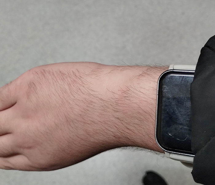 This Patch Of Hairless Skin On My Arm