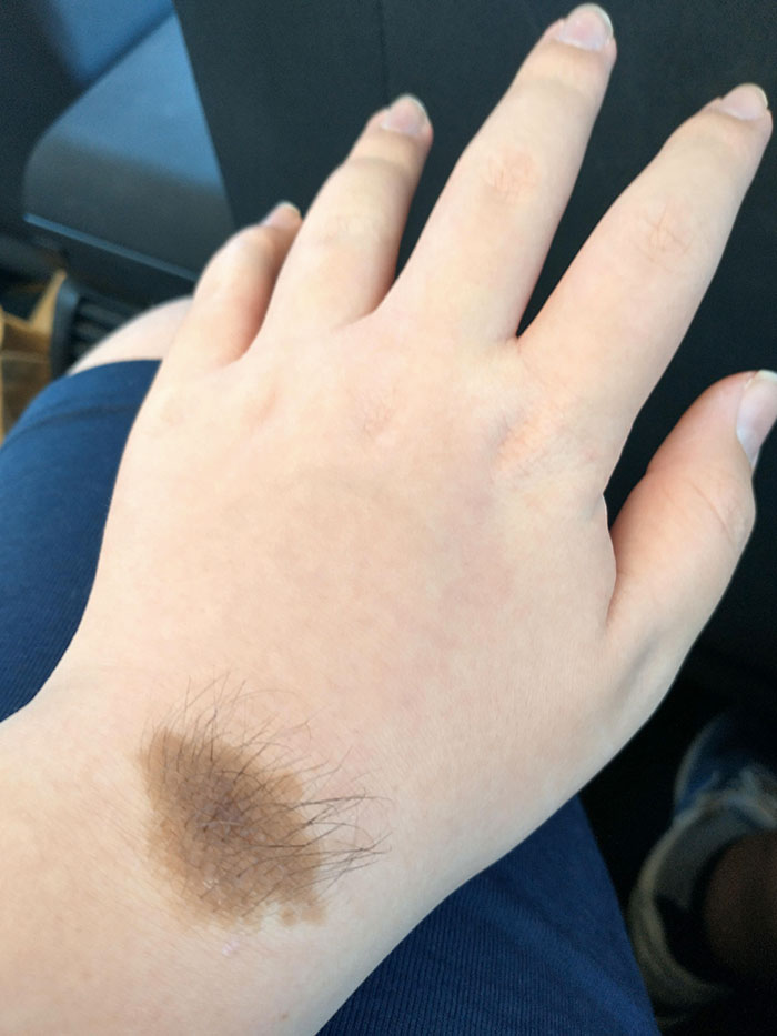 I've Had This Birthmark Since I Was Born. It Even Has Hair