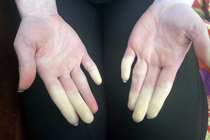 My Partner's Hands When Her Raynaud's Flare Up
