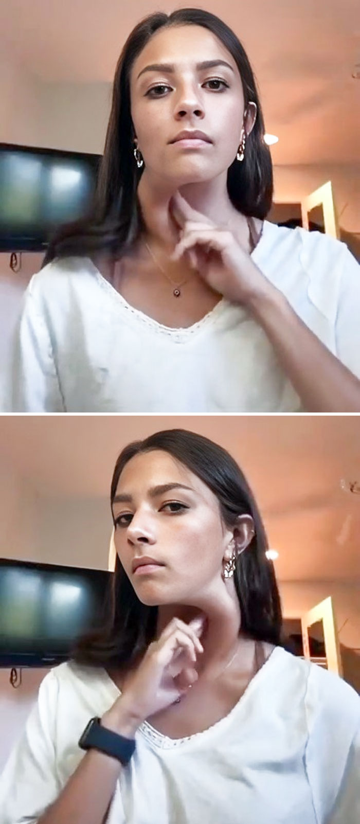 Trachea Hypermobility In Ehlers-Danlos Syndrome