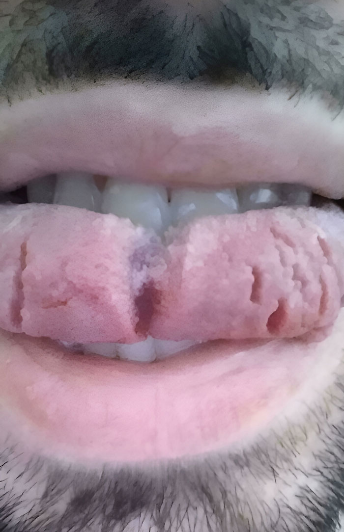 I Have A Geographic Tongue And Fissures
