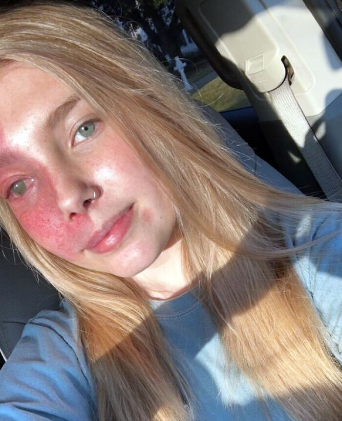 The Sun Hits The Birthmark Just Right. You Are Each Unique In Your Own Way, And So Are Your Birthmarks 