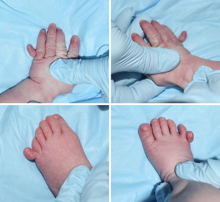 Polydactyly Is The Condition Of Being Born With An Extra Finger Or Toe. Most Of The Time, The Extra Digit Is Smaller Than The Other Digits And Is Not Well-Formed