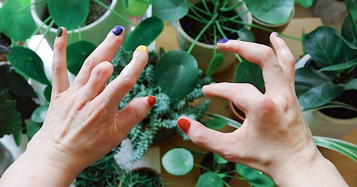 The Hands Of People With Ectrodactyly Tell A Story That Is Unique