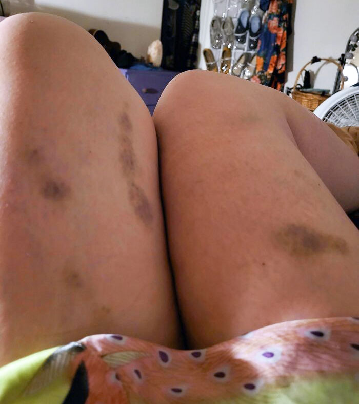Close-up of legs with bruises, resting indoors; a wholesome moment from the veterinarian's office.