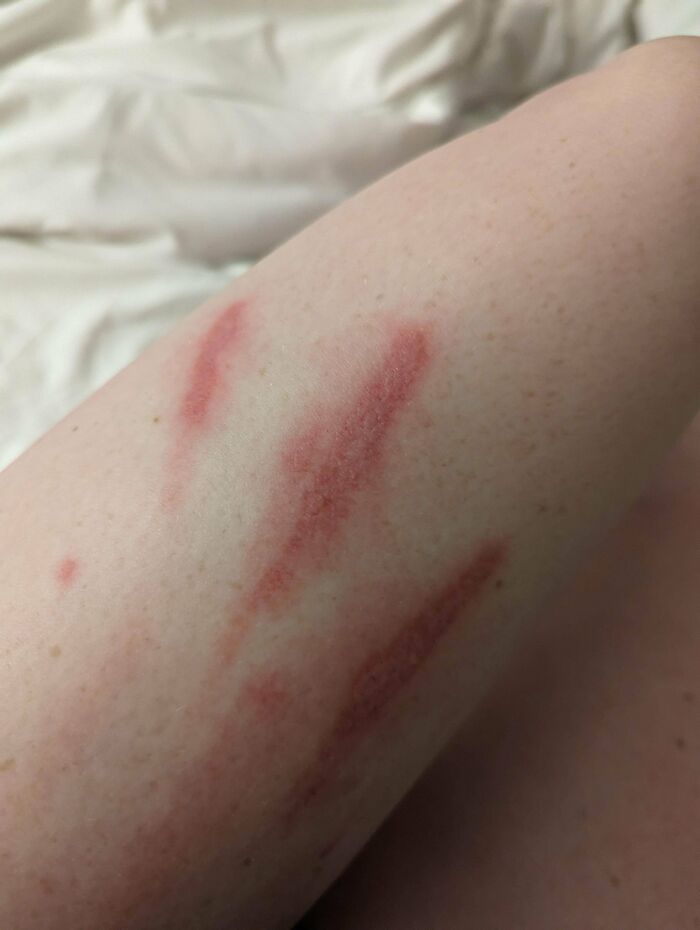 Mark On Leg After Snorkeling In The Caribbean