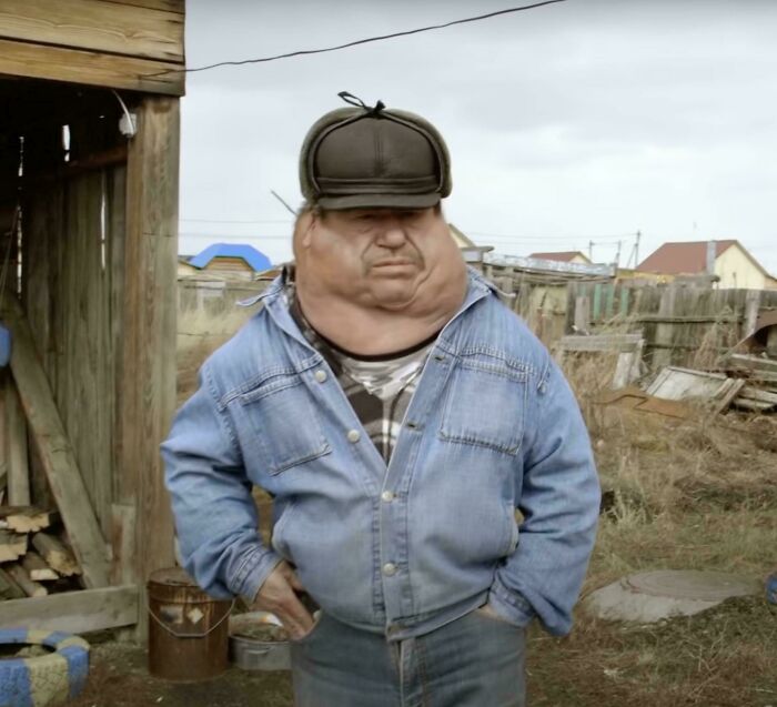 Man With Radiation Poisoning, Chelyabinsk Region, Russia