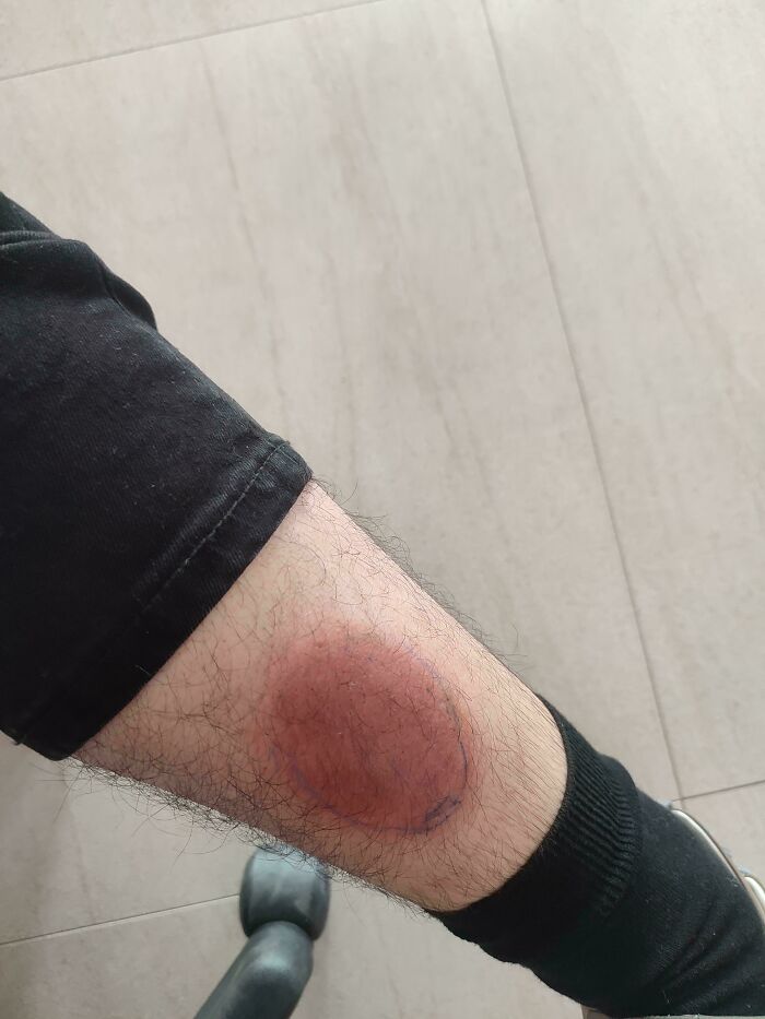 I Woke Up With This On My Leg