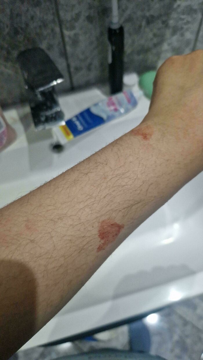 Woke Up And Found Two Patches Of Dried Blood On My Arm With No Cuts Anywhere