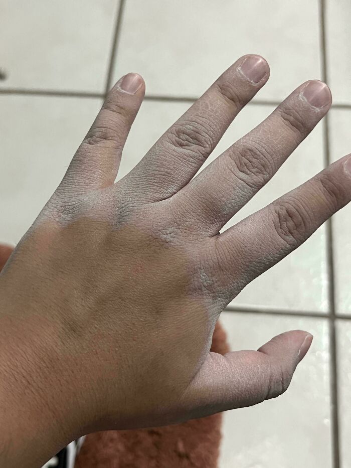 This Happens Every Time I Come In Contact With Hot Water