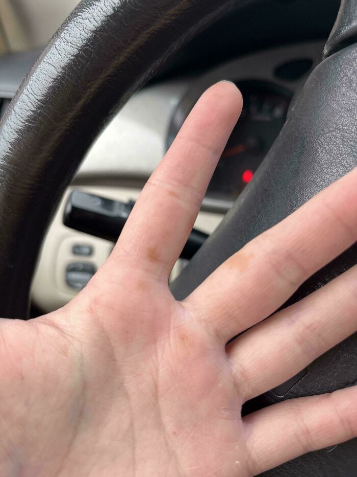 Random Dark Blotches Appeared On My Hand