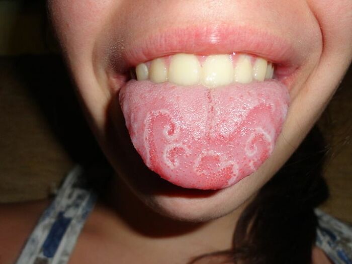 Geographic Tongue