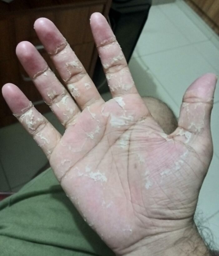 My Hand Skin Sheds Once Every Year