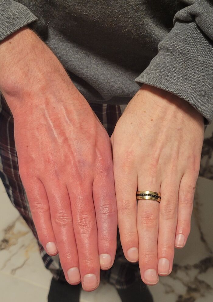 Massive Color Difference Between My Hands