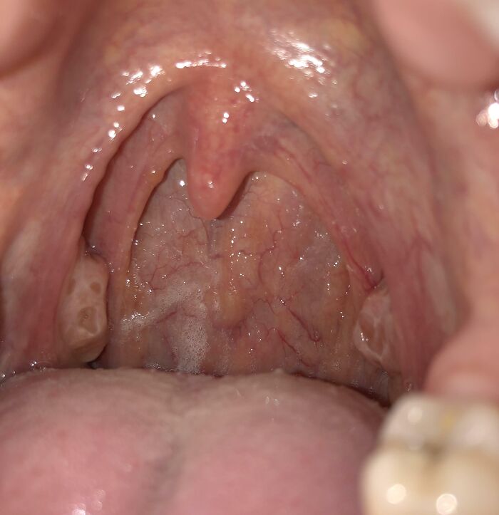 My Tonsil Looks Like It Is Haunted And Screaming In Horror
