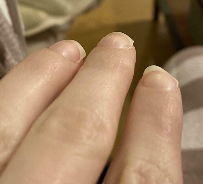 My Index Finger Nail Grows Bending Downward