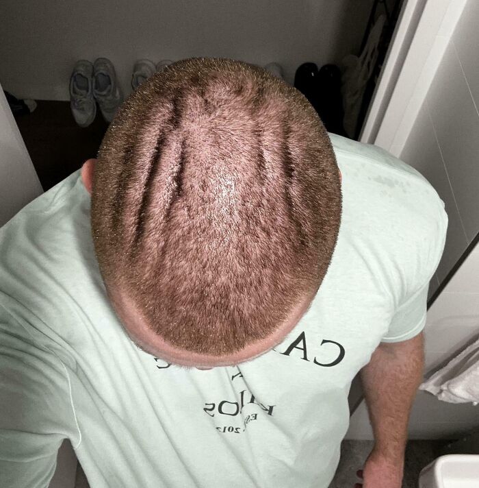 Shaved My Head And Found These Weird Lines In It