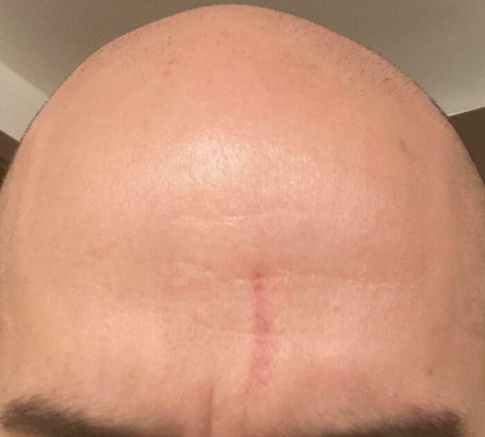 Red Mark That Appears On My Forehead Whenever I Get High