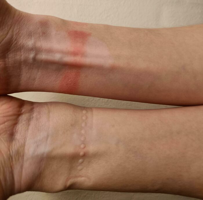 Only My Right Arm Is Allergic To My Wristwatch