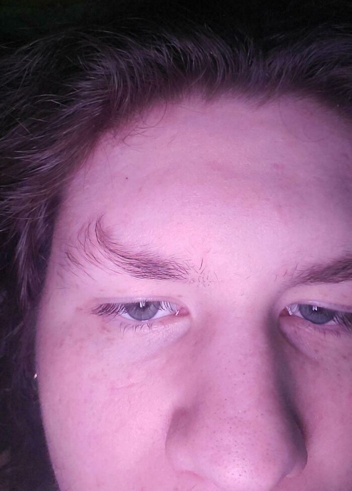 I Was Born With A Crooked Bone In My Skull Resulting In My Unique Eyebrow
