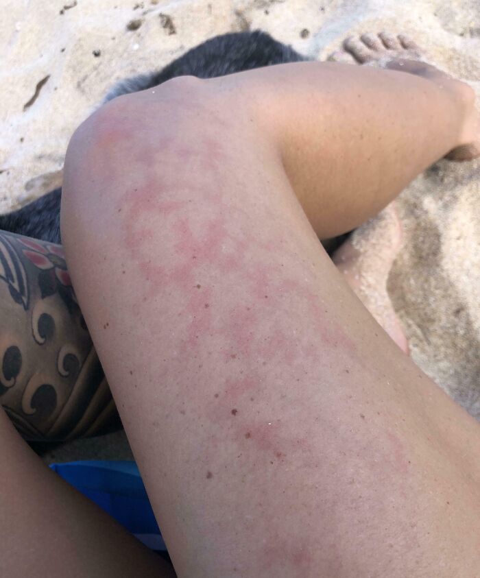 My Skin Gets This Fun Pattern Whenever I’m Cold And Heat Up Really Quickly