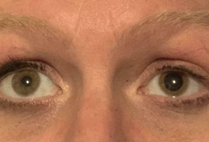 Noticed My Pupils Are Two Different Sizes. I Was Discharged From The Hospital With A Diagnosis Of Anisocoria