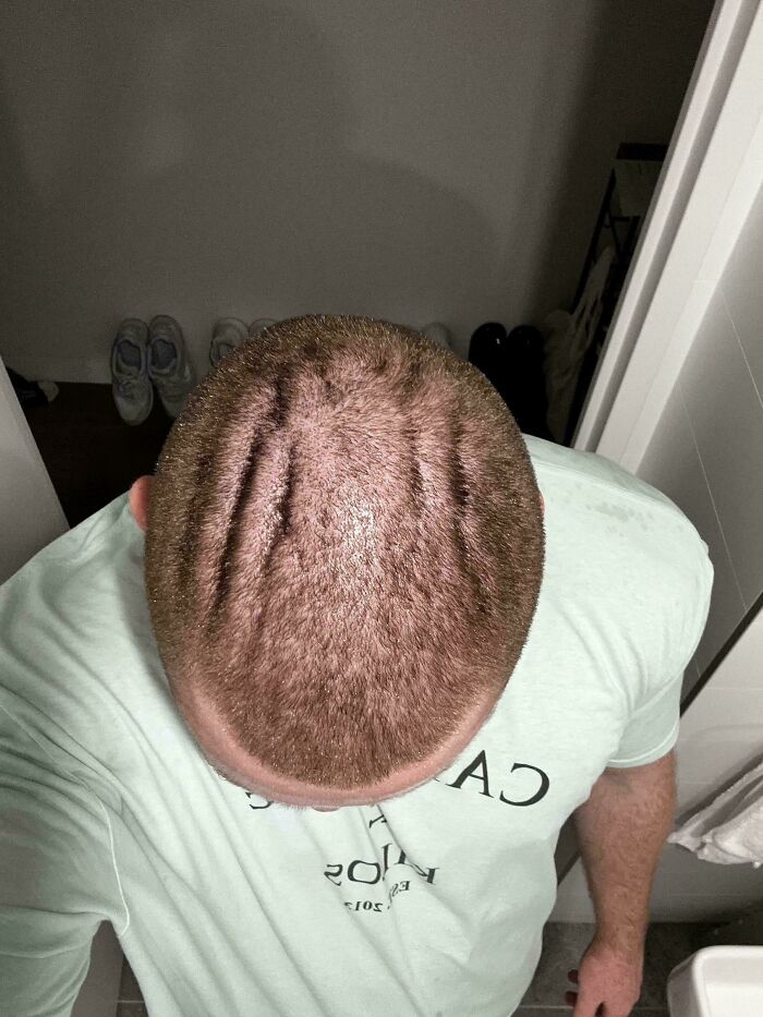 Shaved My Head And Found These Weird Lines In It