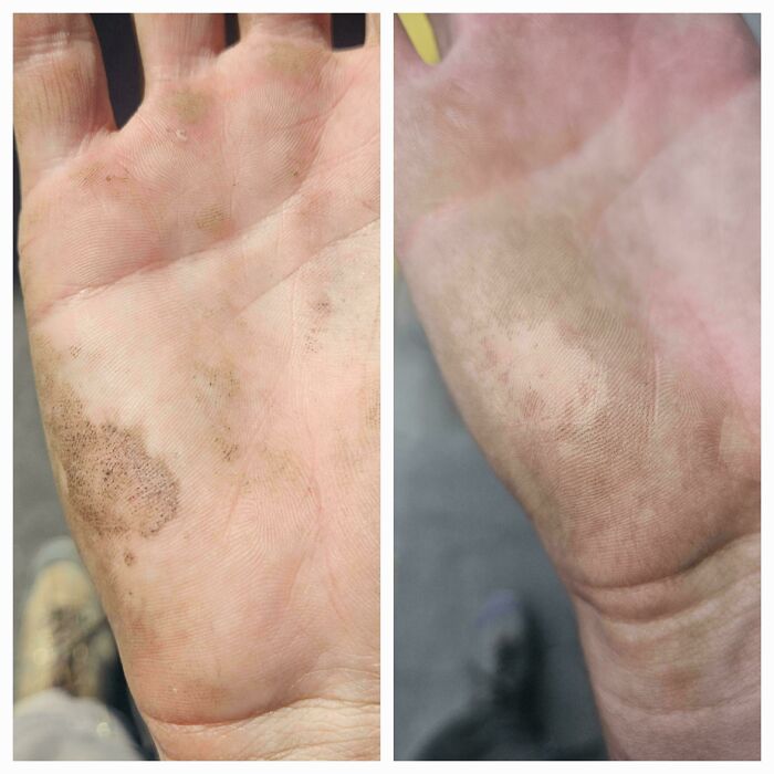 Esta antigua herida en mi mano se queda limpia o sucia, según lo contrario que tenga el resto de la mano