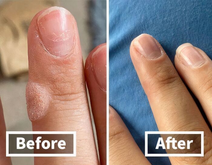 If You Have Been Playing With Too Many Frogs, Try This Compound W Wart Remover To Get Your Hands Back To Looking Like Those Of A Princess