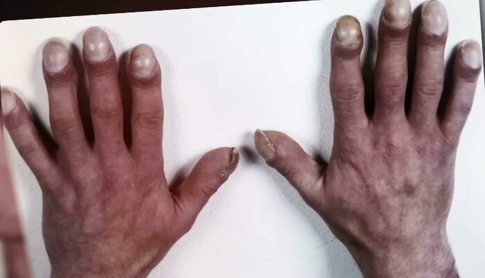 The Hands Of German Serial Killer Fritz Honka