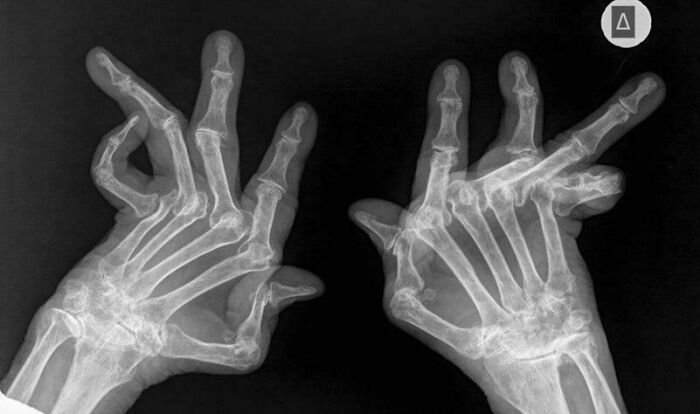 What Severe Rheumatoid Arthritis Looks Like