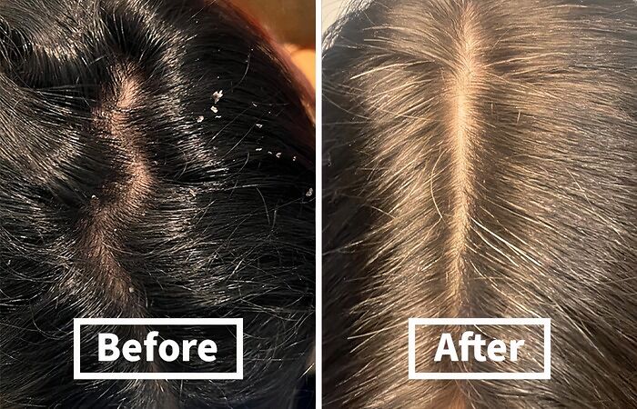  Nizoral’s Anti-Dandruff Shampoo Wont Flake On You