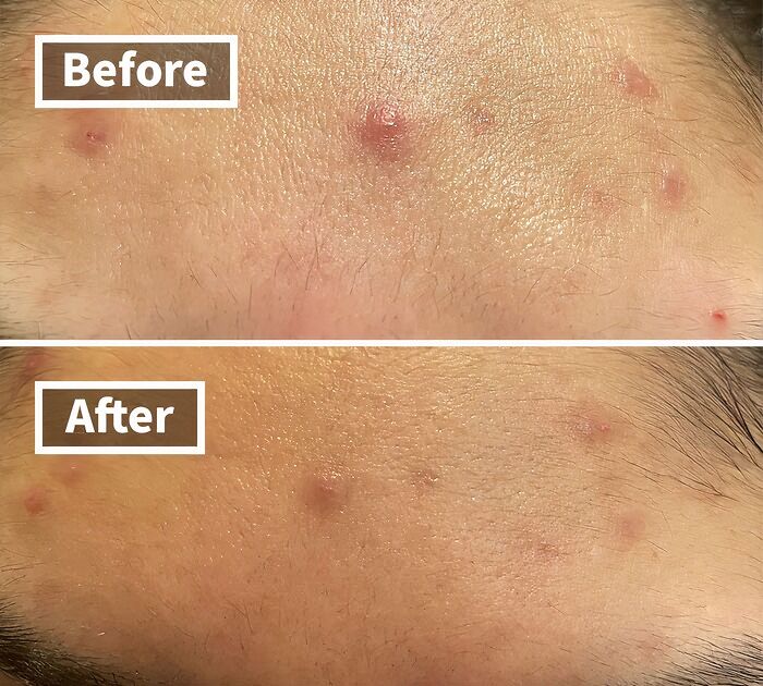 Put Those Dirty Fingers Away! Hydrocolloid Pimple Patches Is The Most Hygenic Way To Zap Those Zits